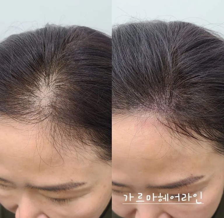 가르마 헤어라인