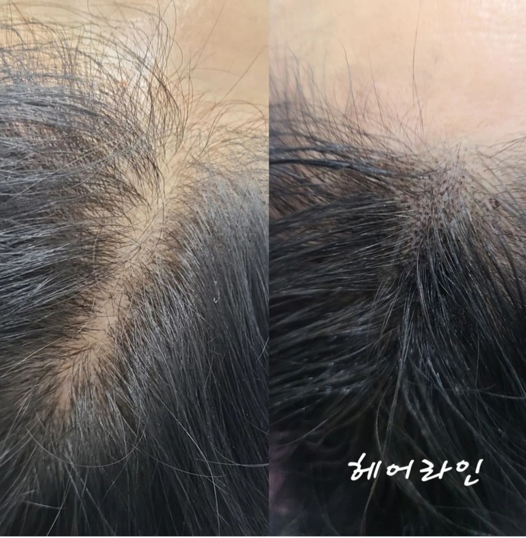 헤어라인