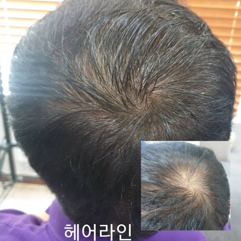 헤어라인