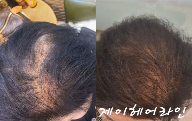 헤어라인 시술