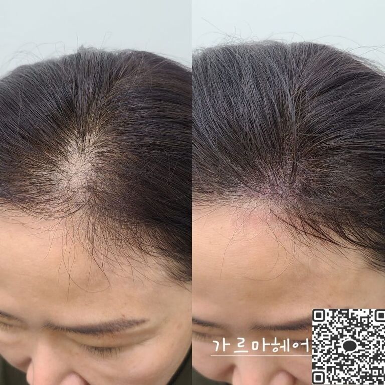 헤어라인 시술