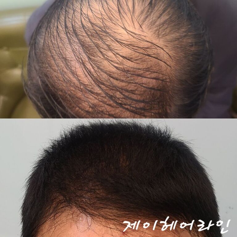 헤어라인 시술