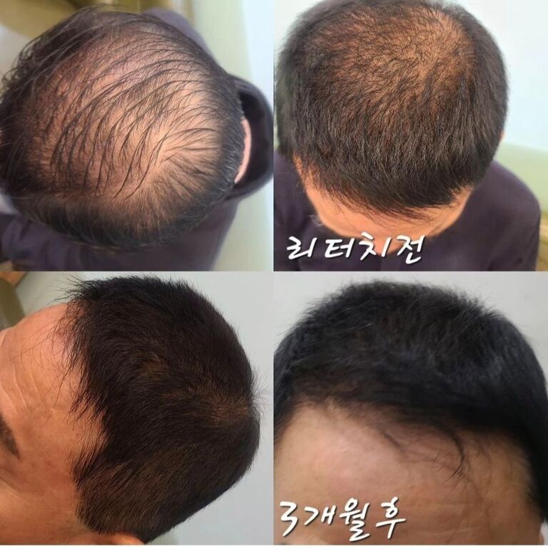 헤어라인 시술